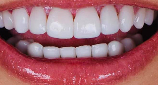 Burke Dental | Sleep Apnea, Emergency Treatment and Sports Mouthguards
