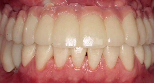 Burke Dental | Veneers, Digital Radiography and Bone Grafts