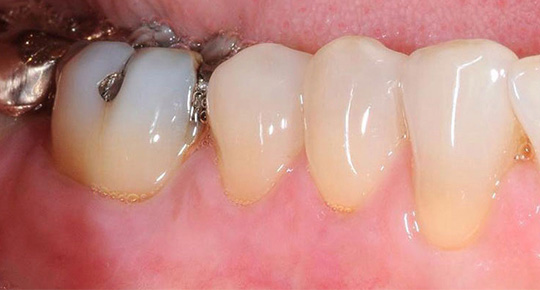 Burke Dental | Pediatric Dentistry, Laser Dentistry and ClearCorrect®