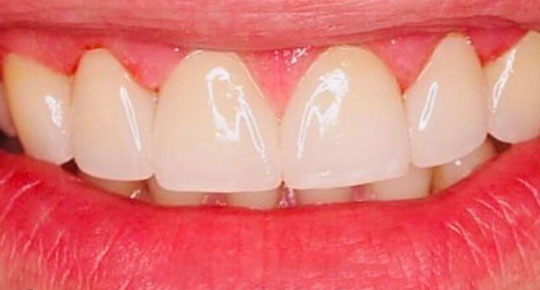 Burke Dental | Night Guards, Full Mouth Reconstruction and Emergency Treatment