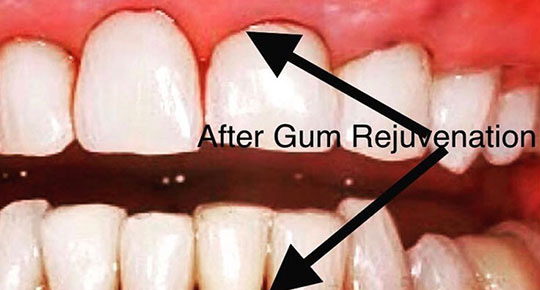 Burke Dental | Dental Fillings, Invisalign® and Digital Impressions