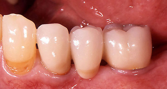 Burke Dental | Night Guards, Digital Impressions and Extractions