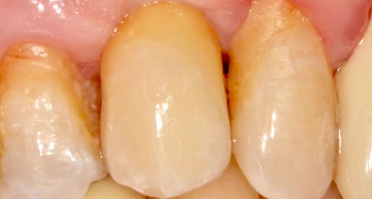 Burke Dental | Sports Mouthguards, Dental Fillings and Wisdom Teeth