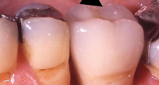 Burke Dental | Root Canals, Sedation Dentistry and Invisalign®