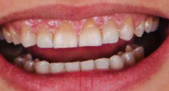 Burke Dental | Preventative Program, iTero® Element Intraoral Scanner  and Teeth Whitening