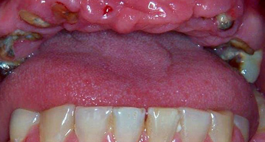 Burke Dental | Sedation Dentistry, Night Guards and Invisalign®