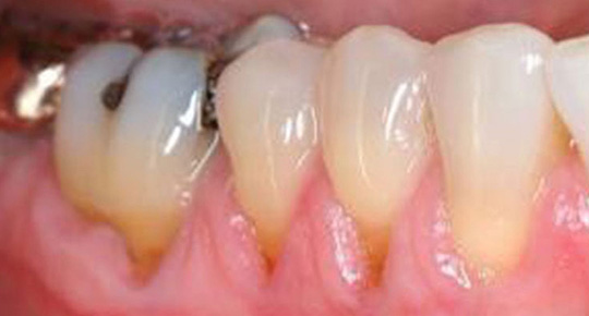 Burke Dental | Cosmetic Dentistry, Fluoride Treatment and TMJ Disorders