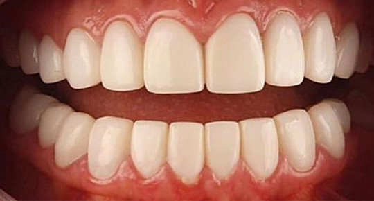 Burke Dental | Dental Cleanings, Inlays & Onlays and Teeth Whitening