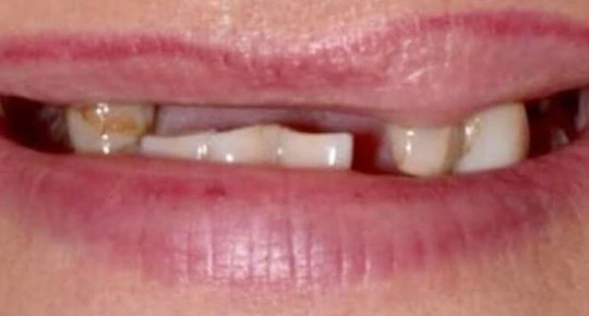 Burke Dental | Inlays & Onlays, Intraoral Camera and Cosmetic Smile Makeover