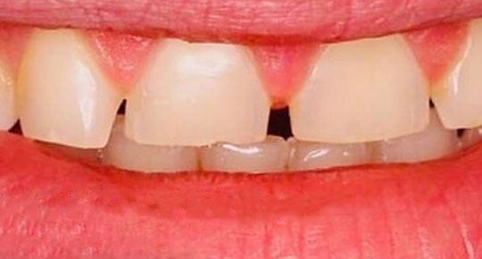 Burke Dental | Dental Bridges, iTero® Element Intraoral Scanner  and Dental Cleanings