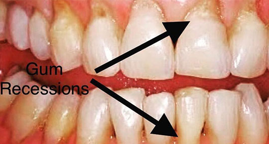 Burke Dental | Wisdom Teeth, Bone Grafts and Oral Cancer Screening