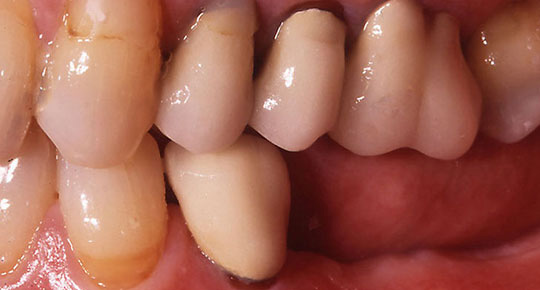 Burke Dental | Veneers, Digital Radiography and Bone Grafts