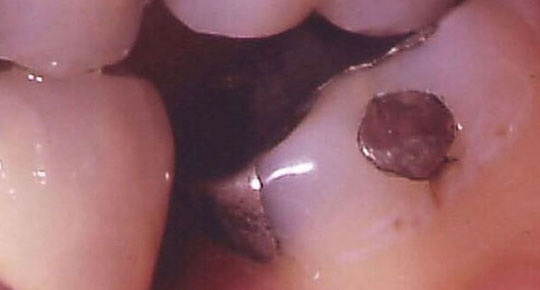 Burke Dental | Root Canals, Digital Impressions and Sleep Apnea