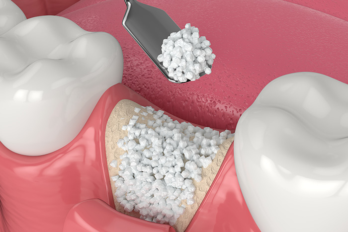 Burke Dental | Sleep Apnea, Oral Cancer Screening and Ceramic Crowns