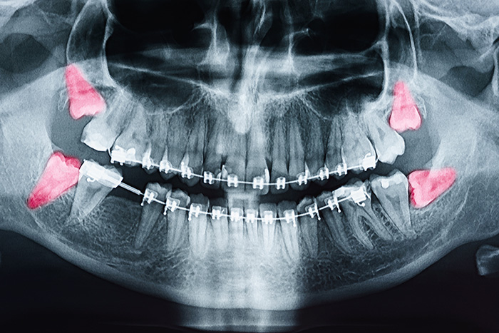 Burke Dental | Dental Lab, Extractions and Dental Sealants